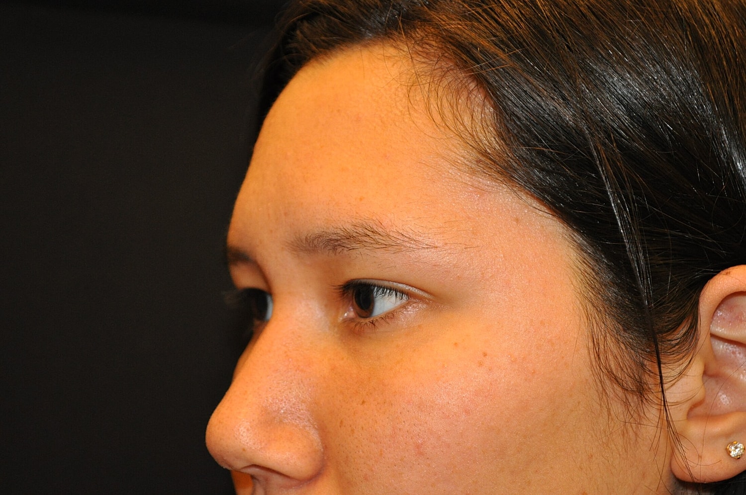 Blephroplasty Before & After