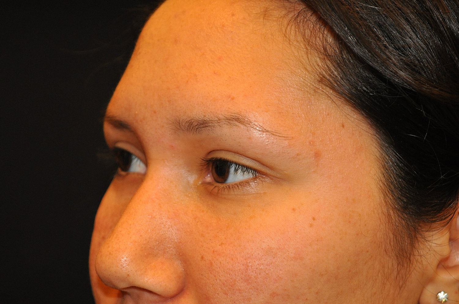 Blephroplasty Before & After