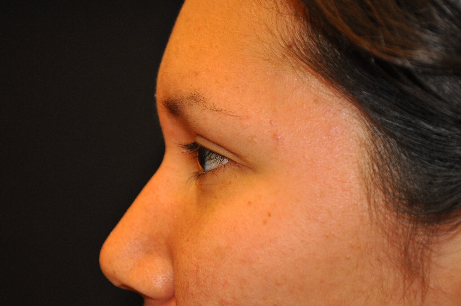 Blephroplasty Before & After