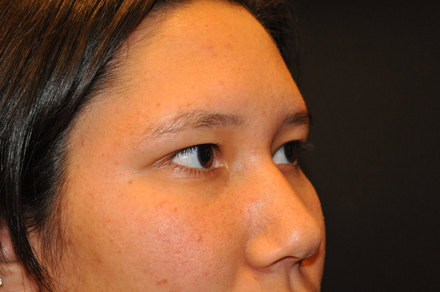 Blephroplasty Before & After