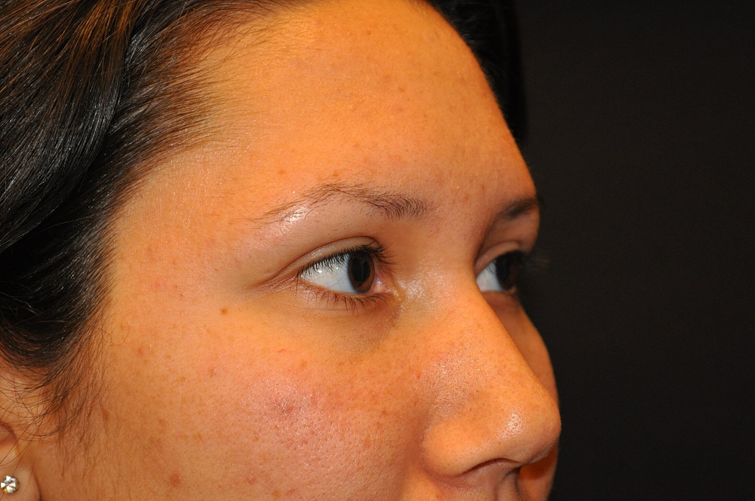 Blephroplasty Before & After