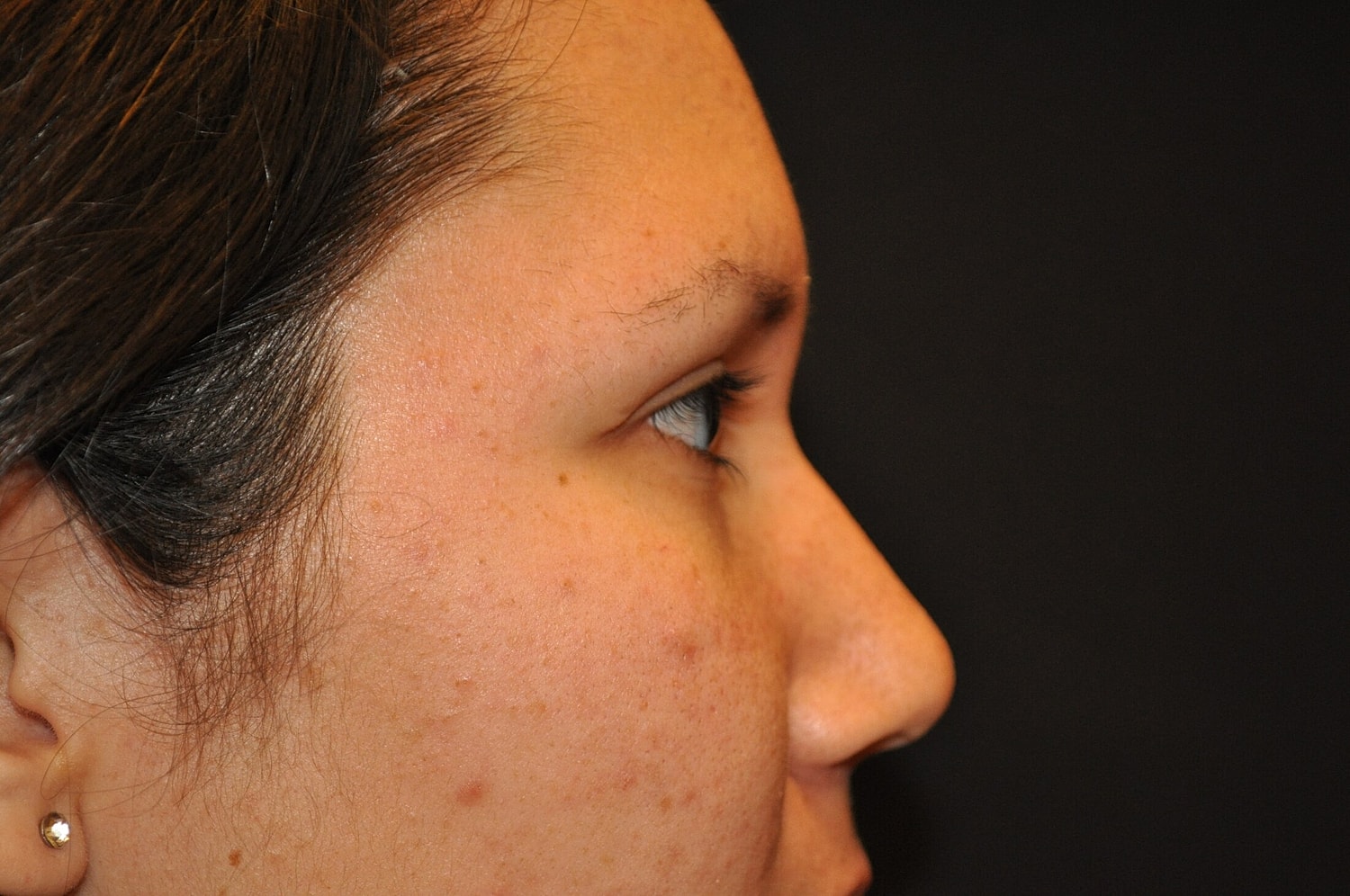 Blephroplasty Before & After