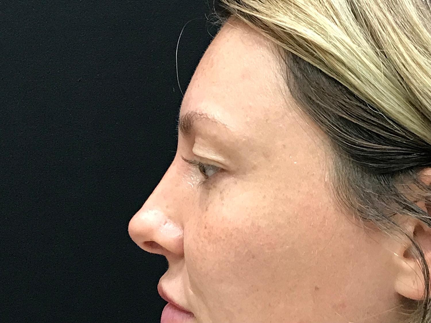 Blephroplasty [.block]Gallery[] Before & After