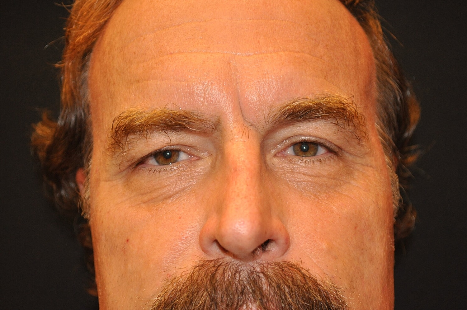 Blephroplasty Before & After