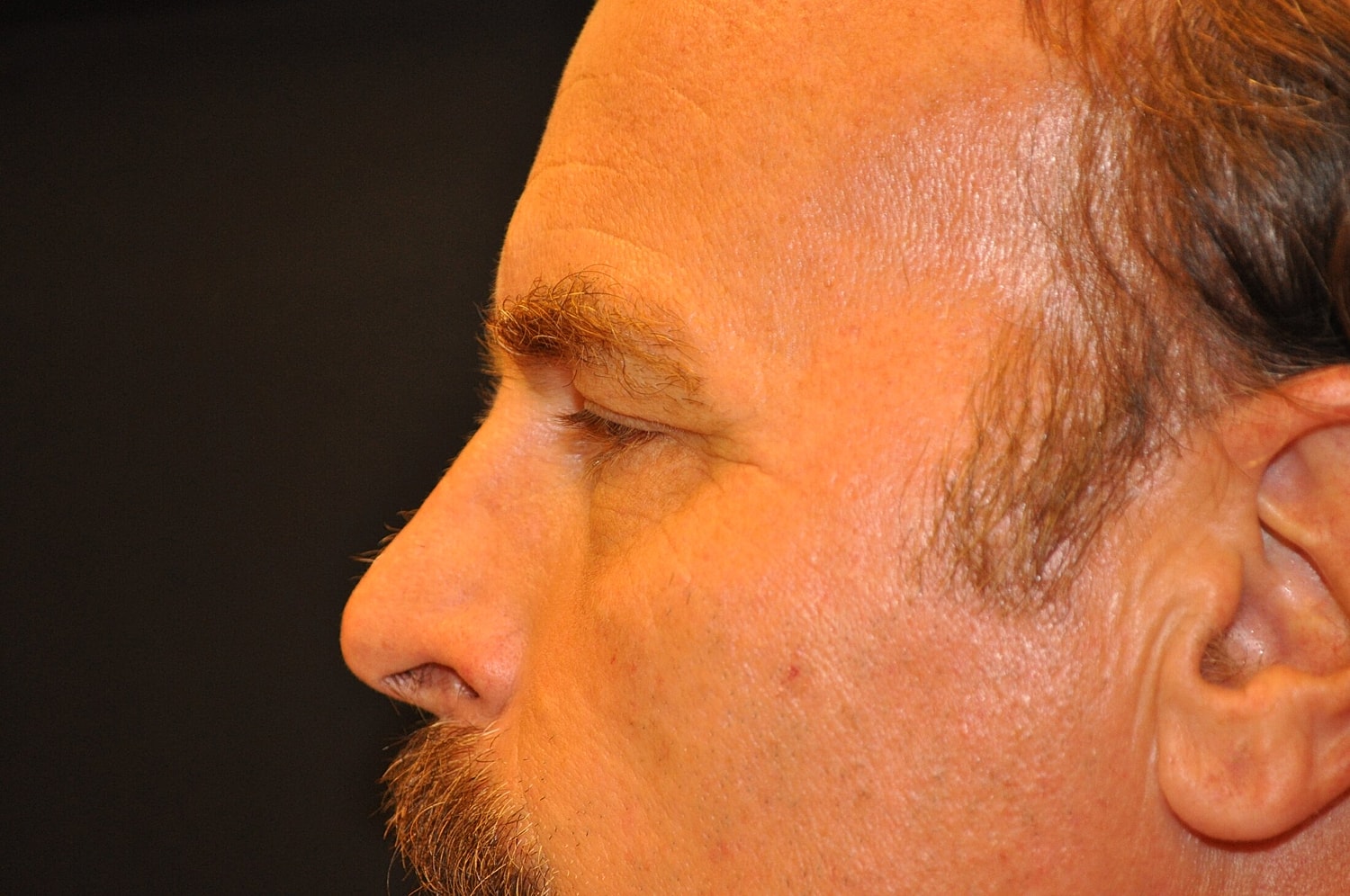 Blephroplasty Before & After