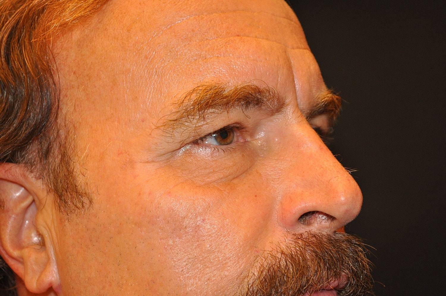 Blephroplasty Before & After