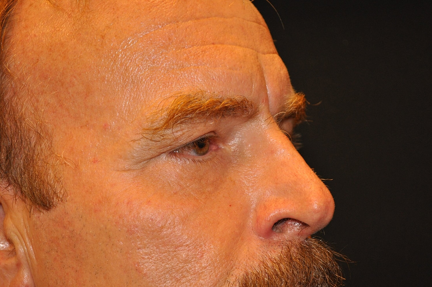 Blephroplasty Before & After