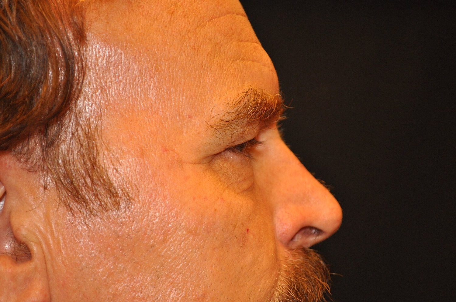 Blephroplasty Before & After