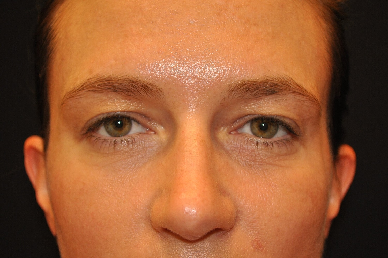 Blephroplasty Before & After