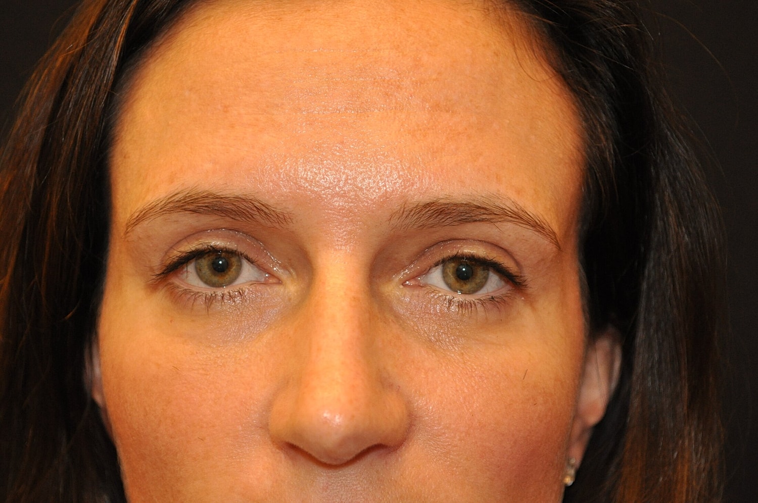 Blephroplasty Before & After