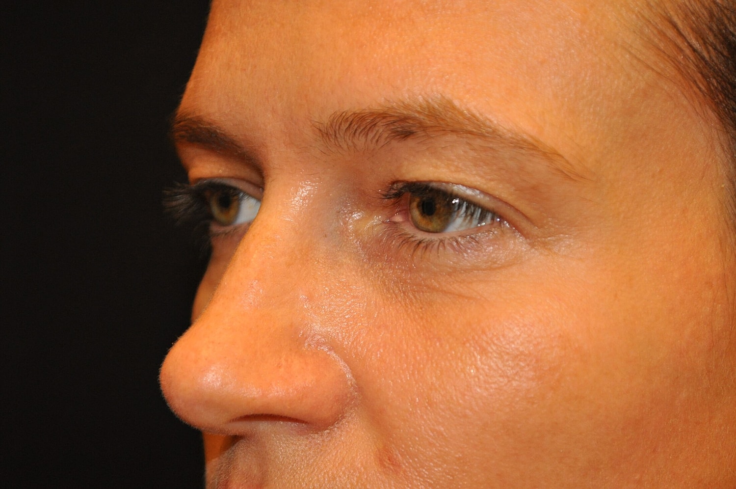 Blephroplasty Before & After