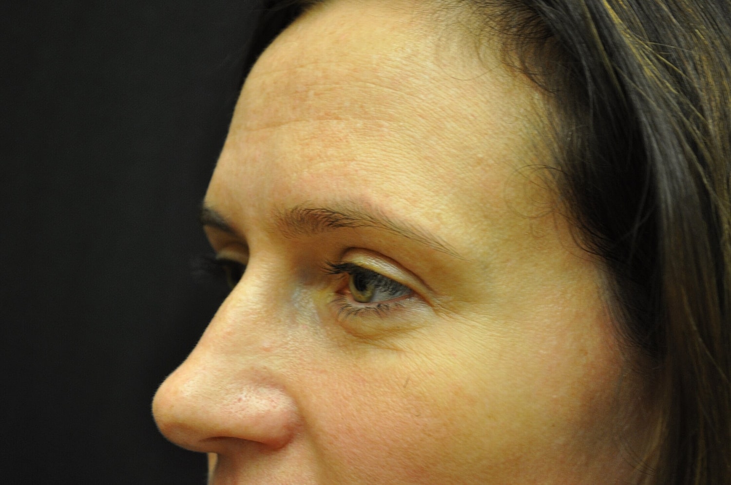 Blephroplasty Before & After