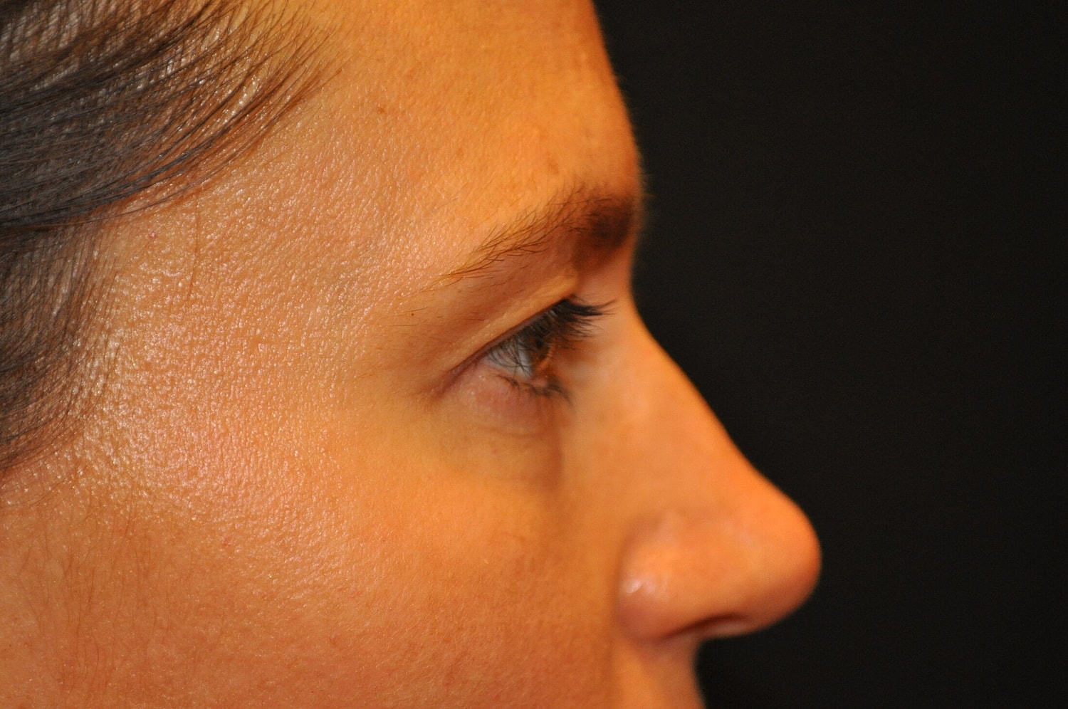 Blephroplasty Before & After