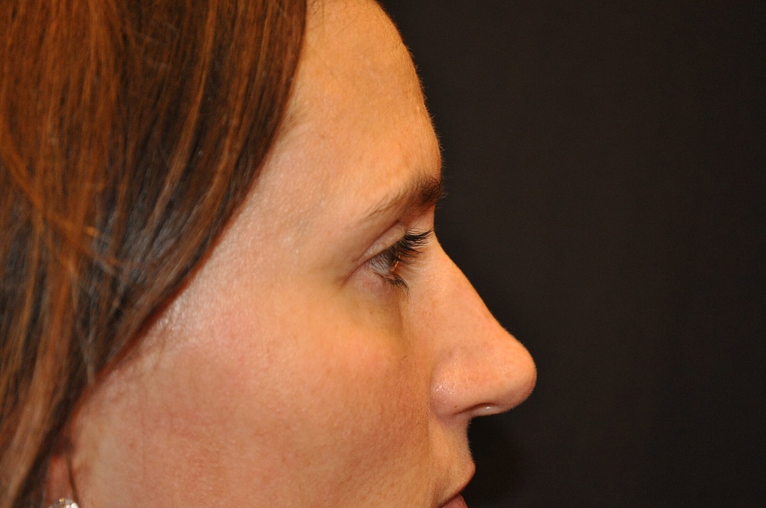 Blephroplasty Before & After