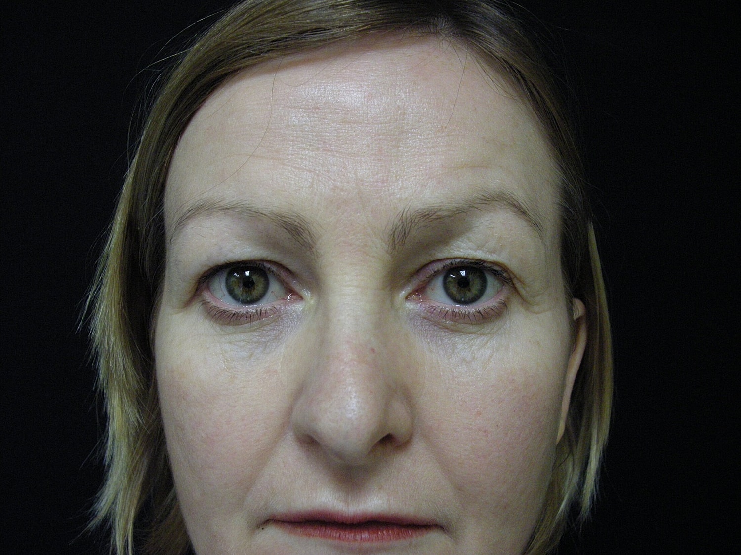 Blephroplasty Before & After