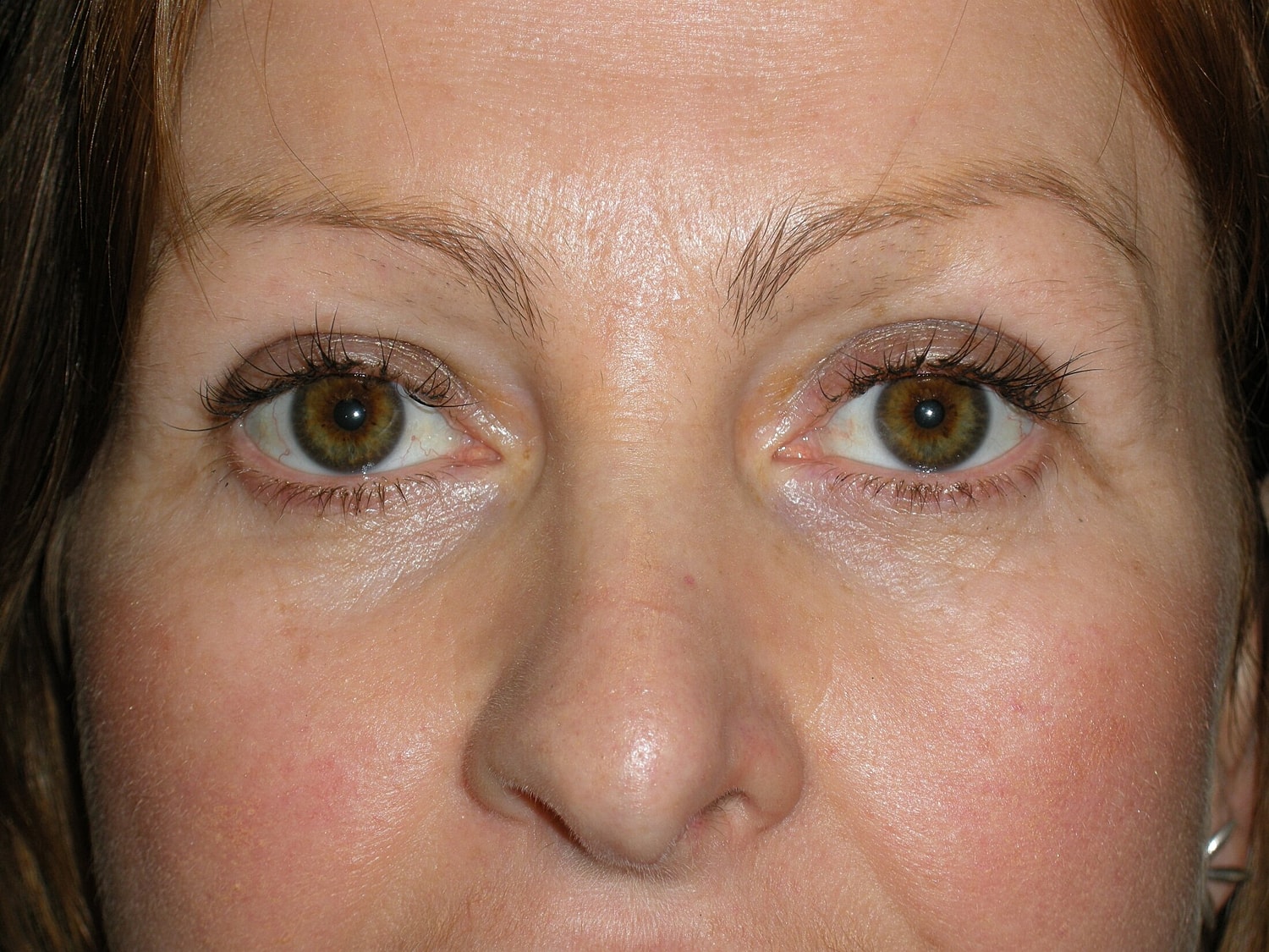 Blephroplasty Before & After