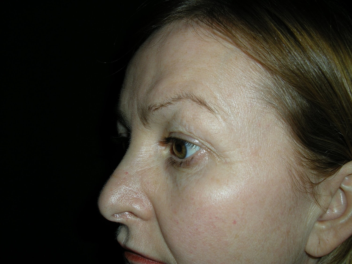 Blephroplasty Before & After