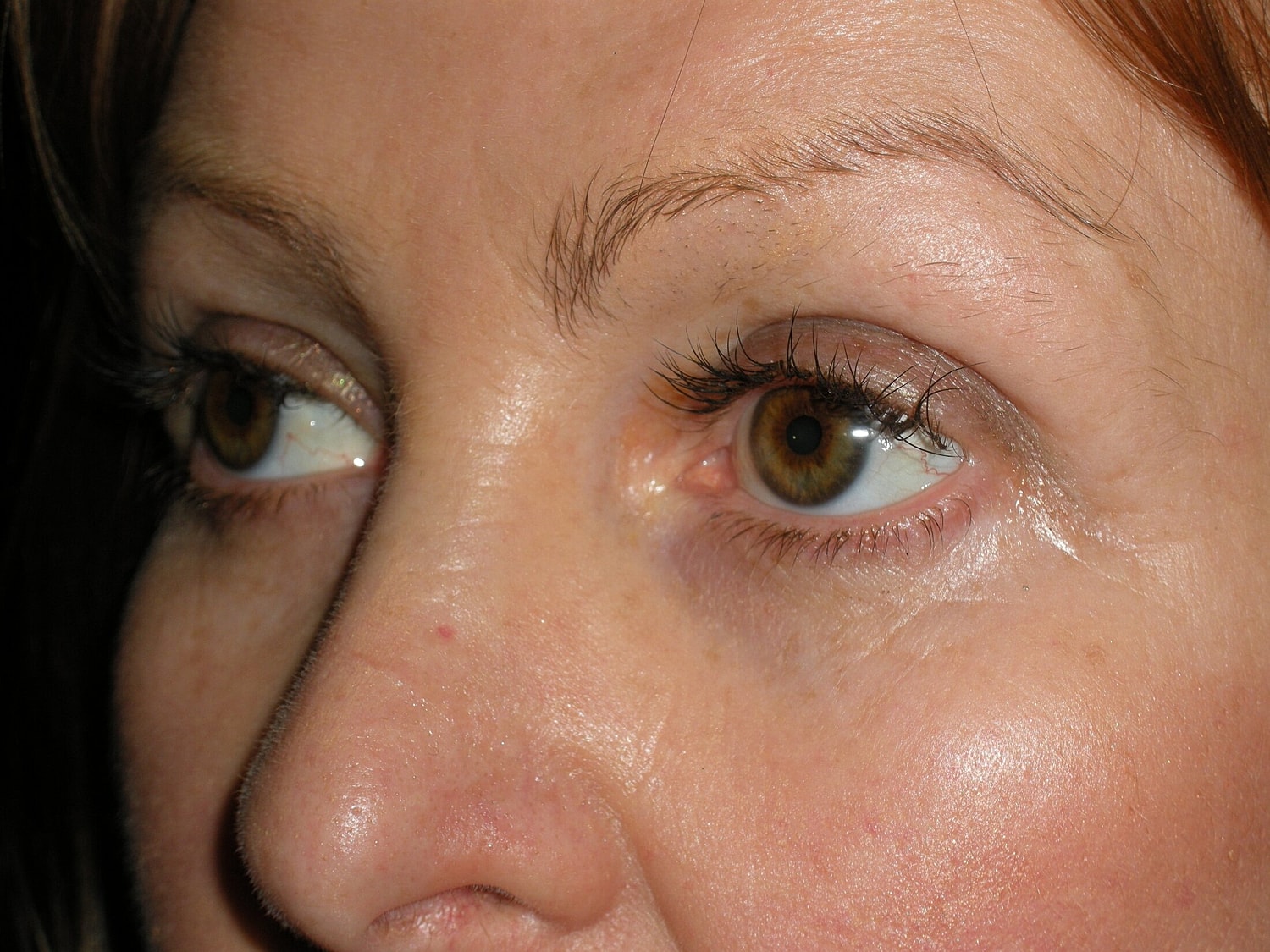 Blephroplasty Before & After