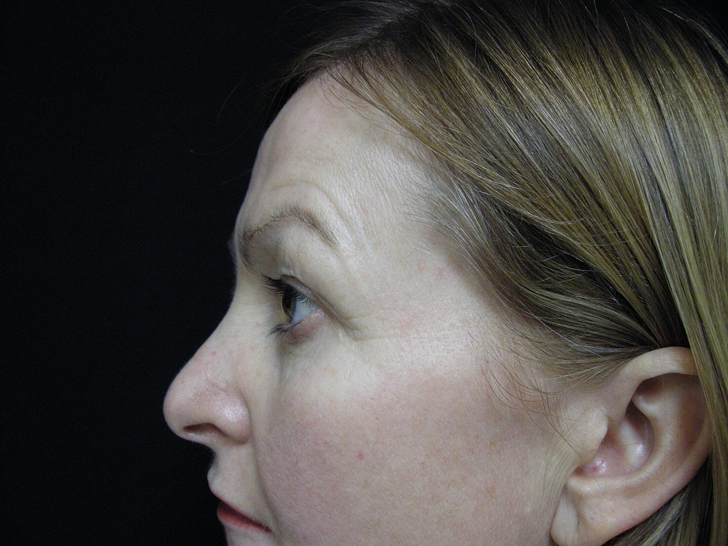 Blephroplasty Before & After