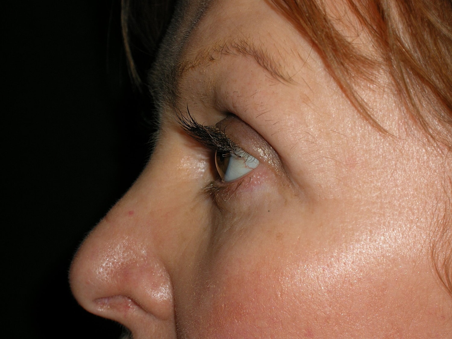 Blephroplasty Before & After