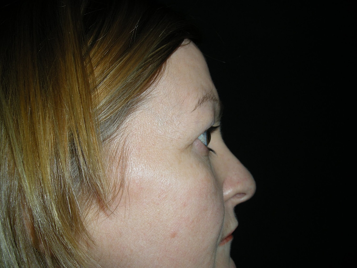 Blephroplasty Before & After