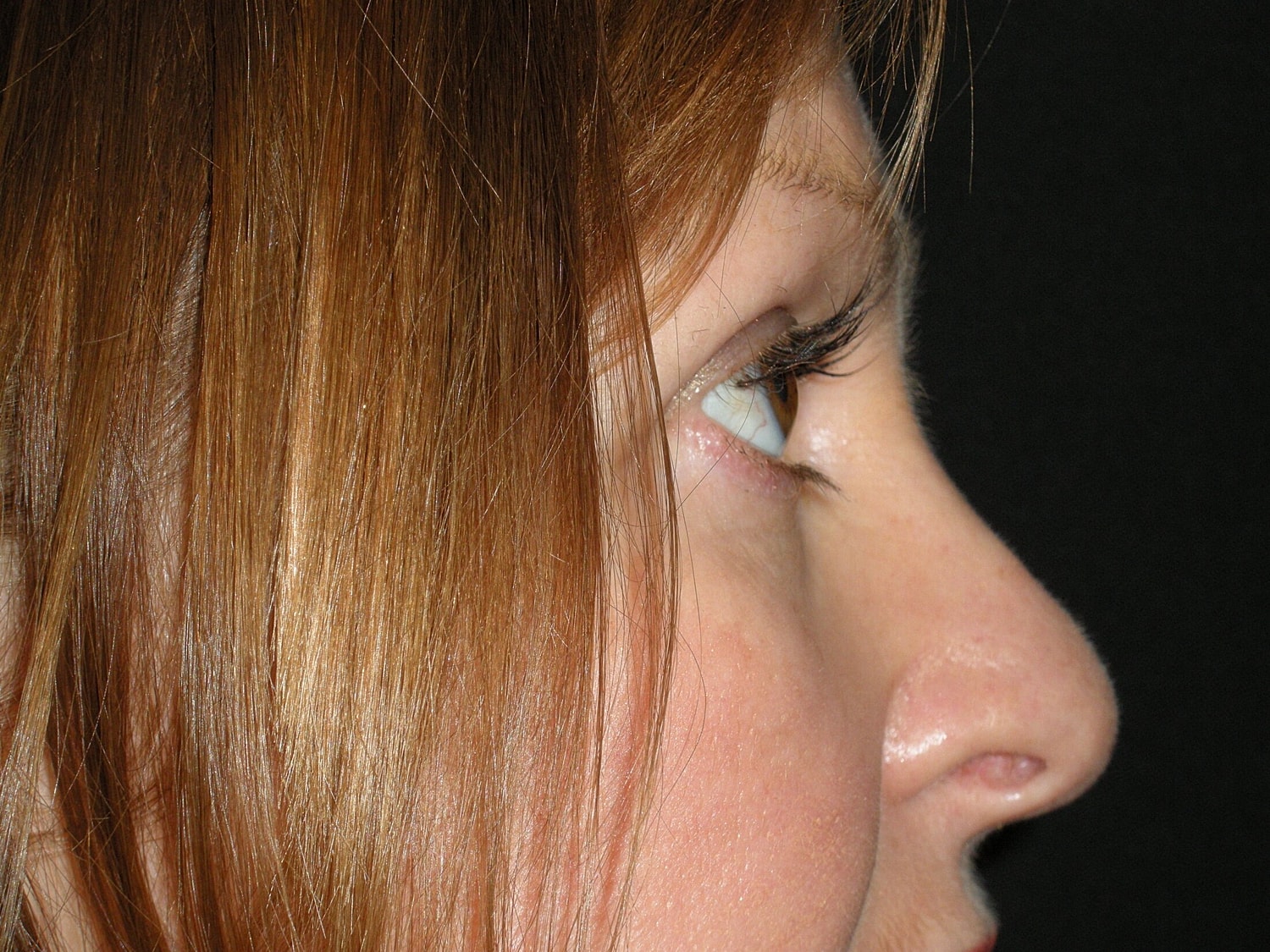 Blephroplasty Before & After