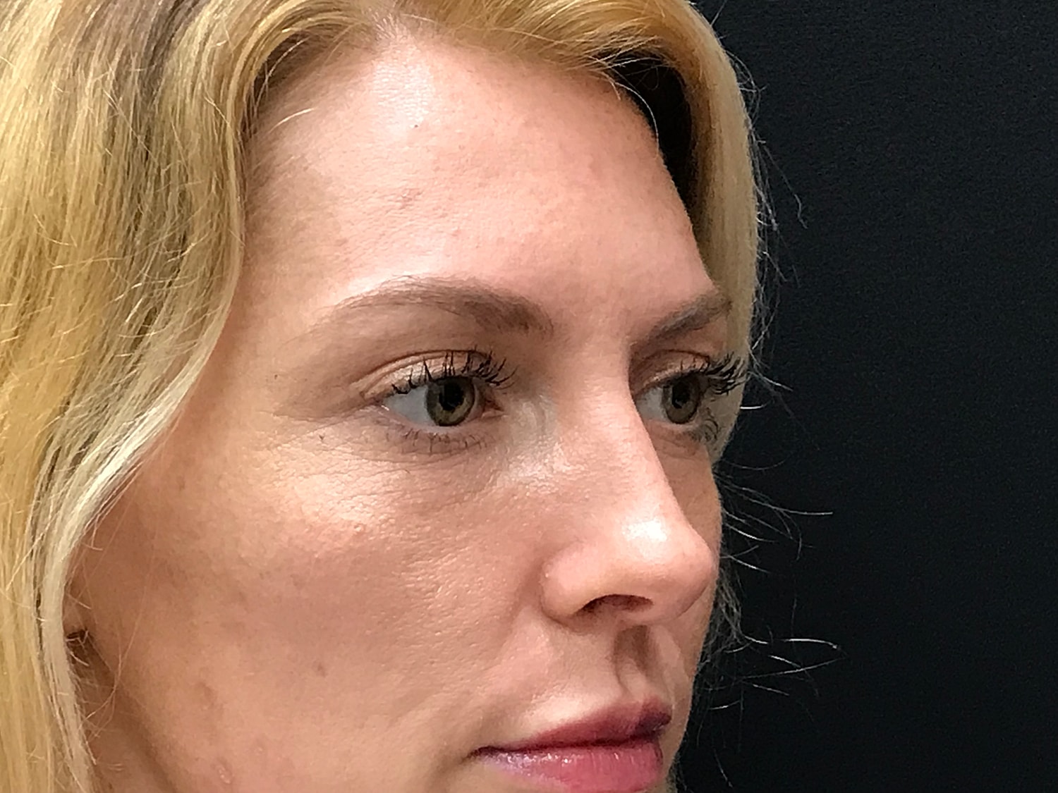 Blephroplasty [.block]Gallery[] Before & After