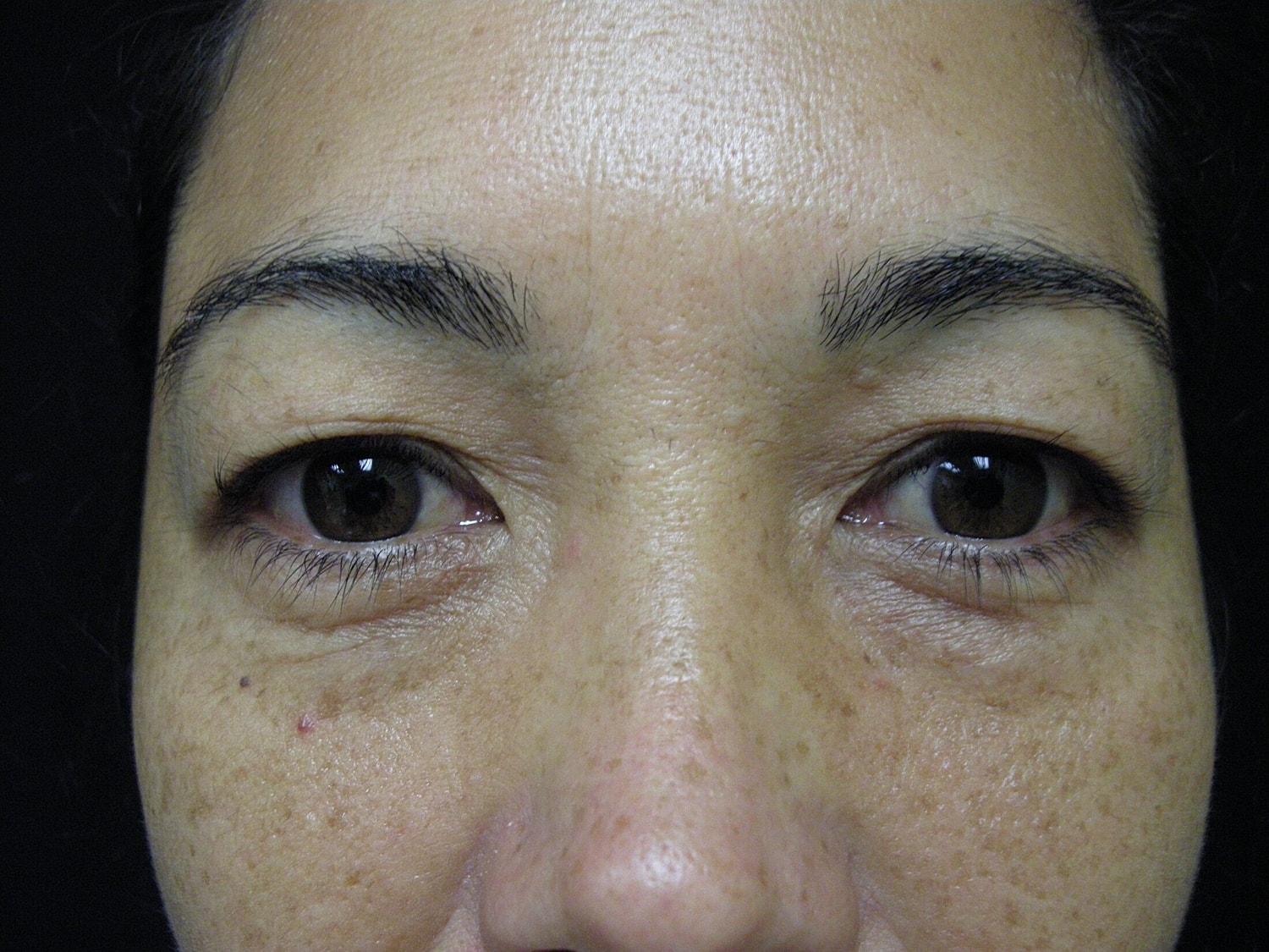 Blephroplasty Before & After