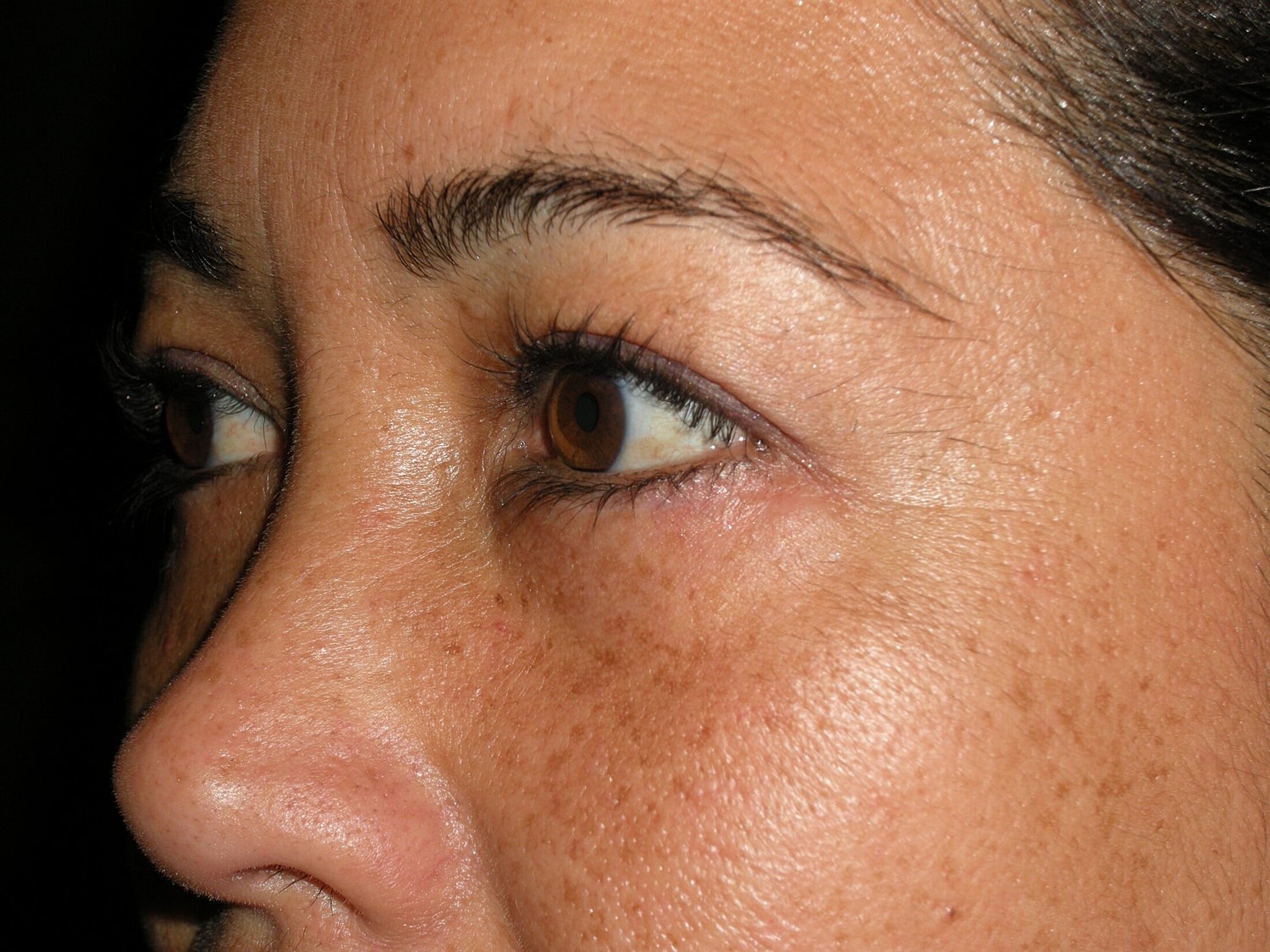 Blephroplasty Before & After