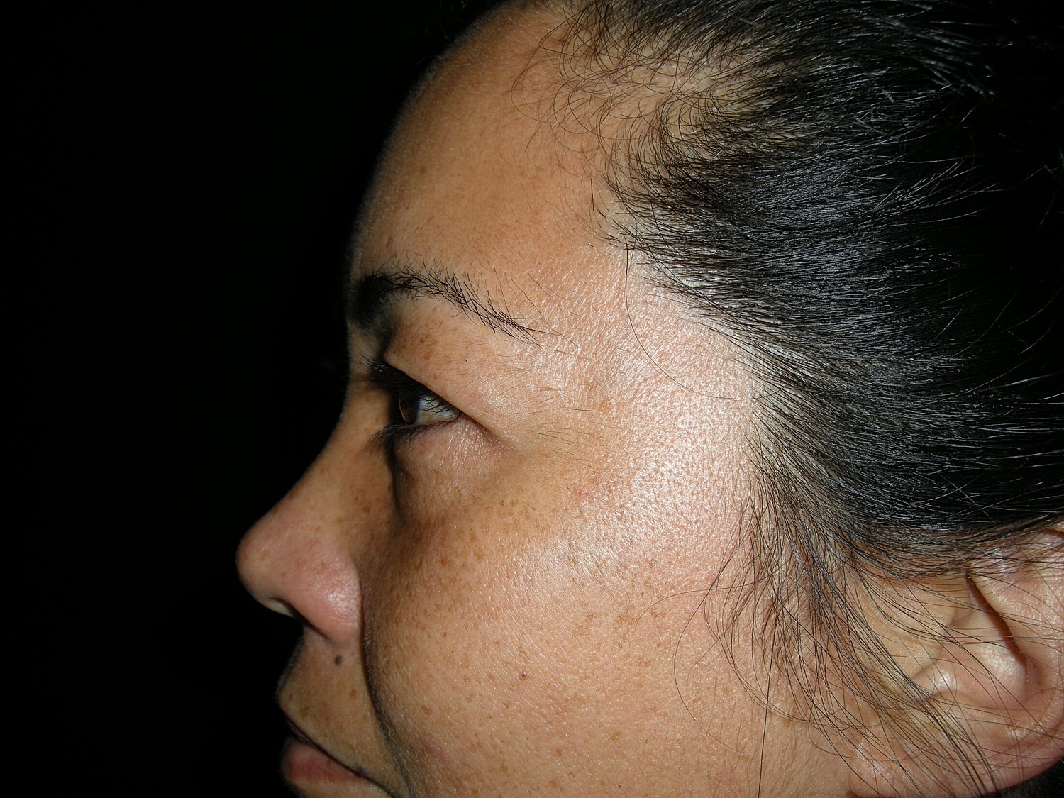 Blephroplasty Before & After