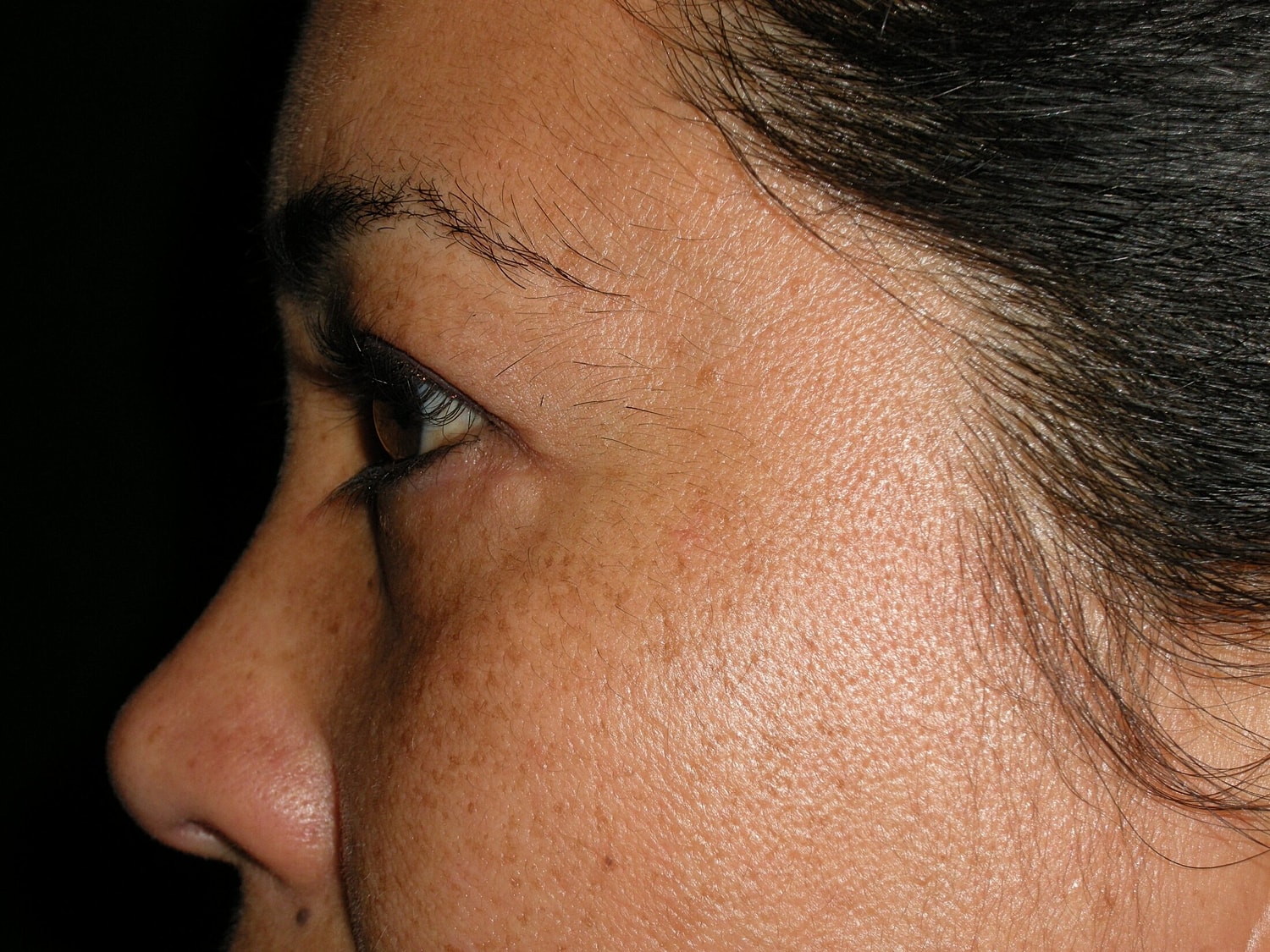 Blephroplasty Before & After