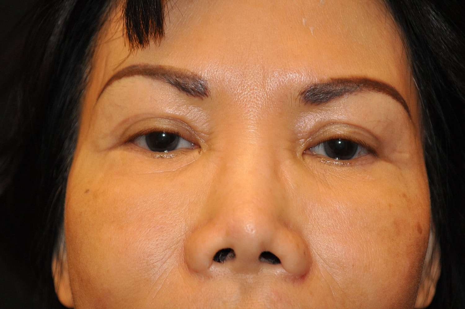 Blephroplasty Before & After