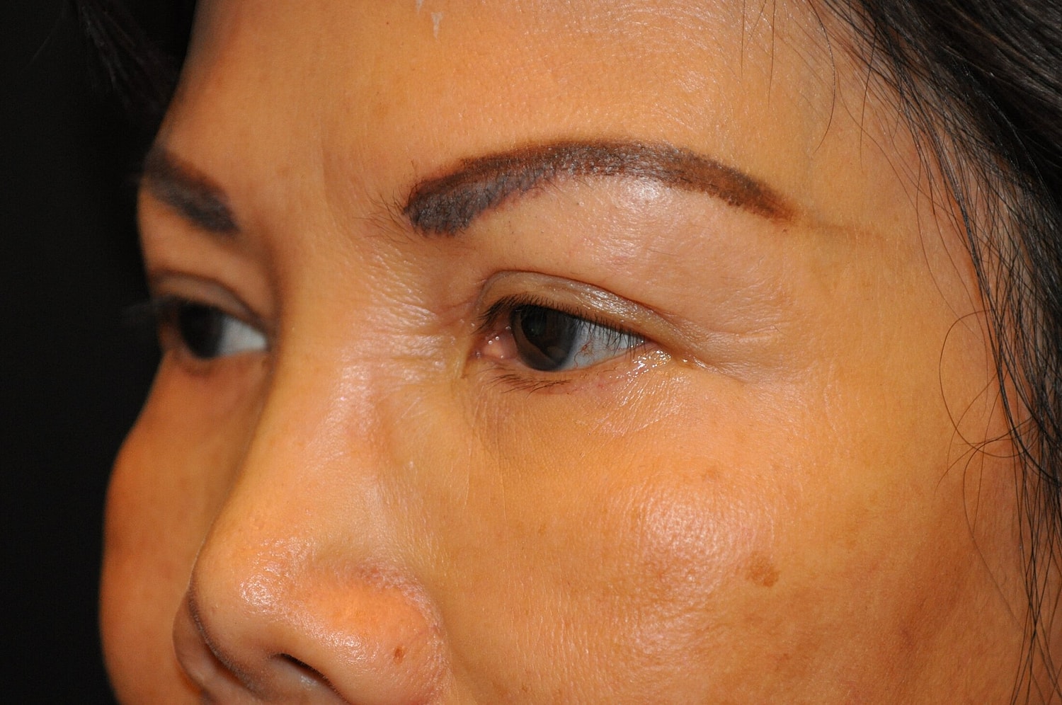 Blephroplasty Before & After