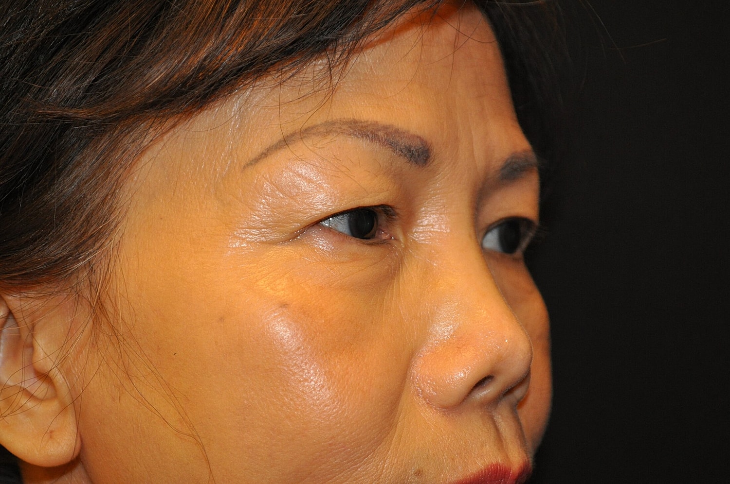 Blephroplasty Before & After