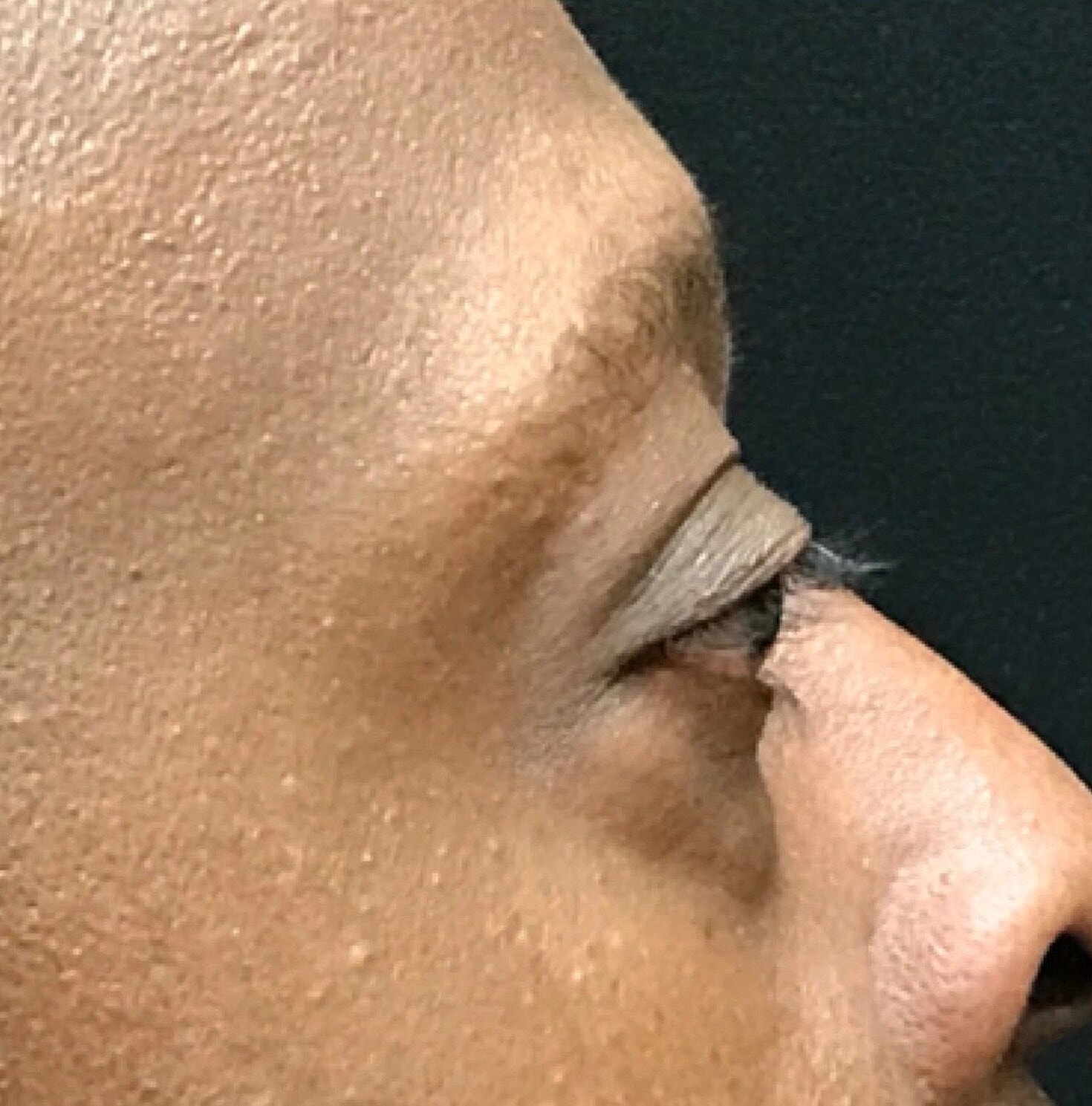 Blephroplasty Before & After