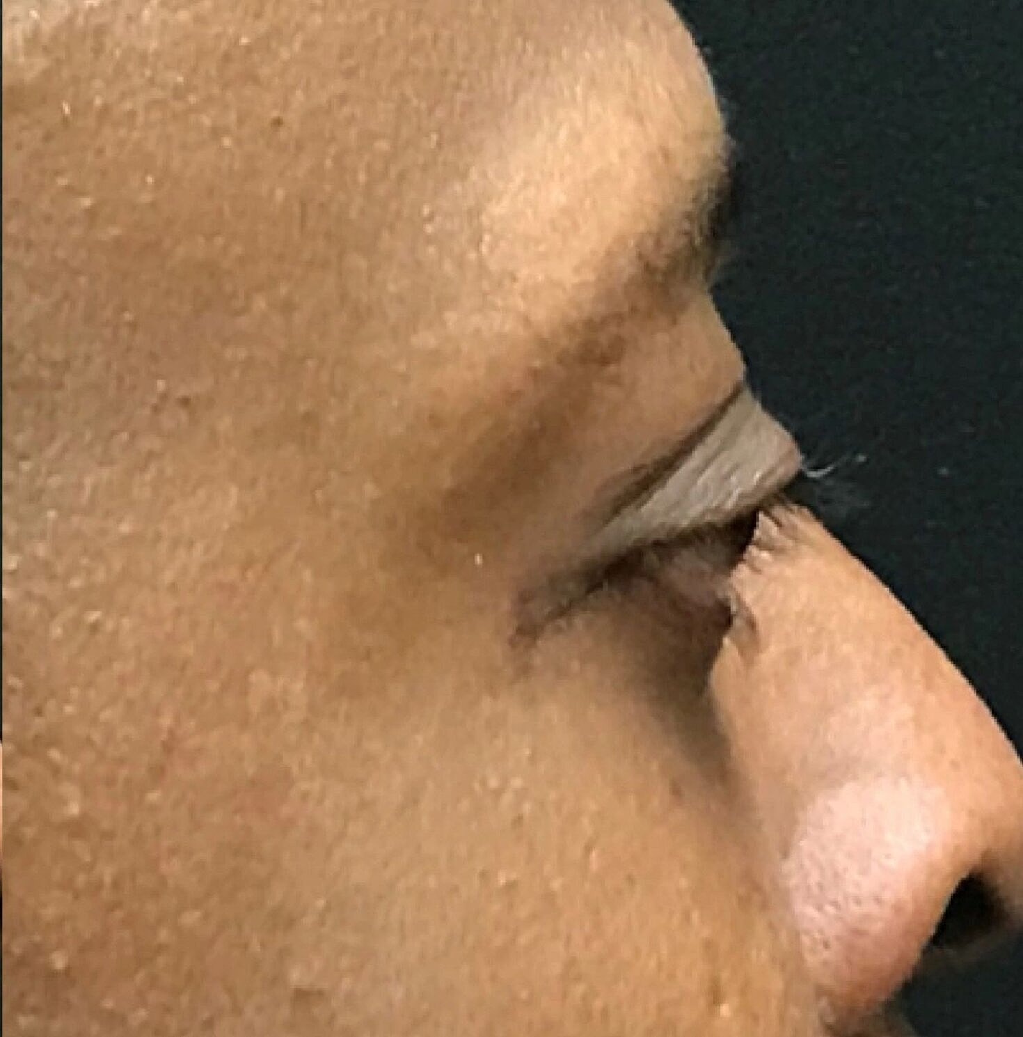 Blephroplasty Before & After