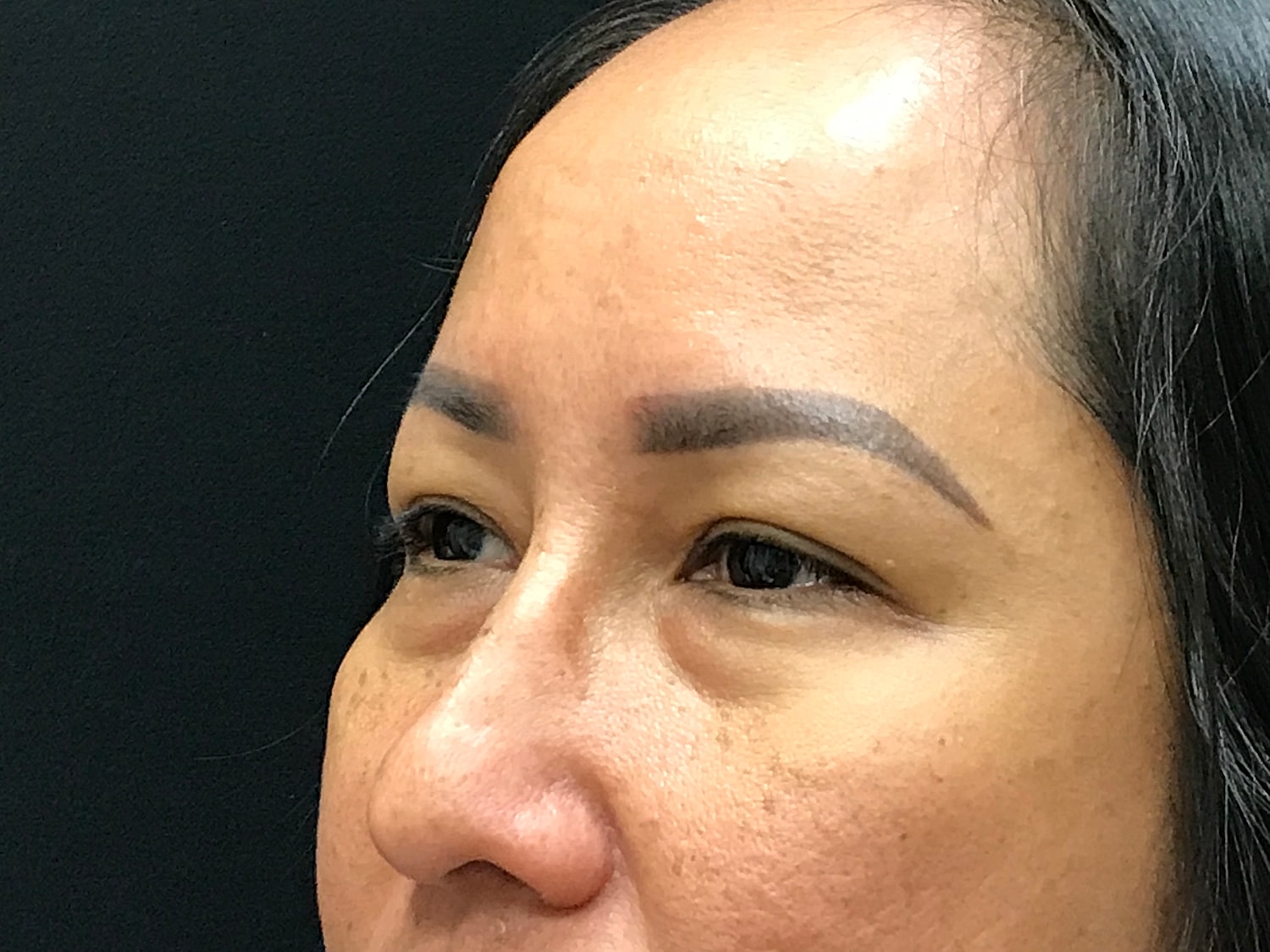 Blephroplasty [.block]Gallery[] Before & After