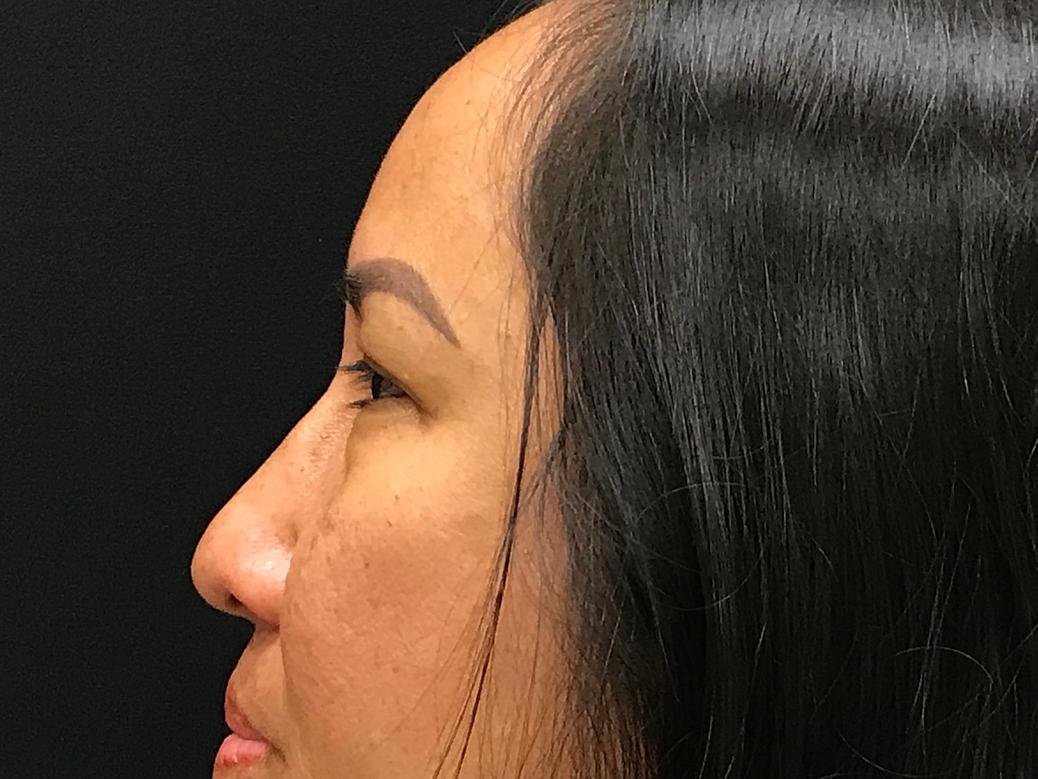 Blephroplasty [.block]Gallery[] Before & After