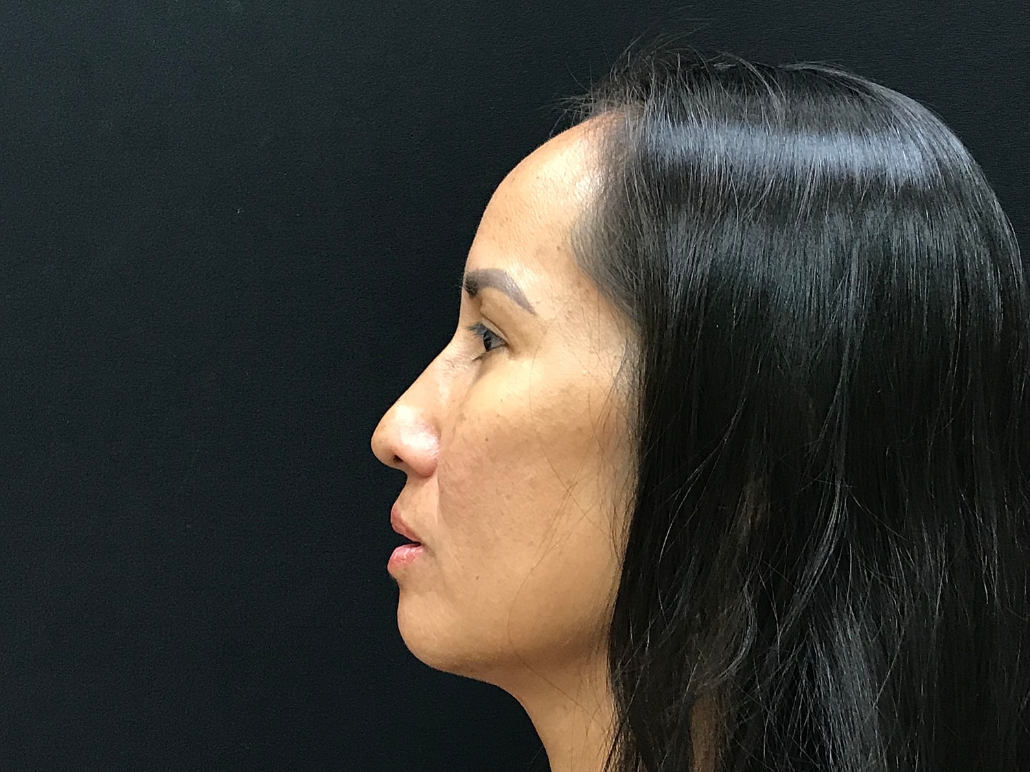 Blephroplasty [.block]Gallery[] Before & After