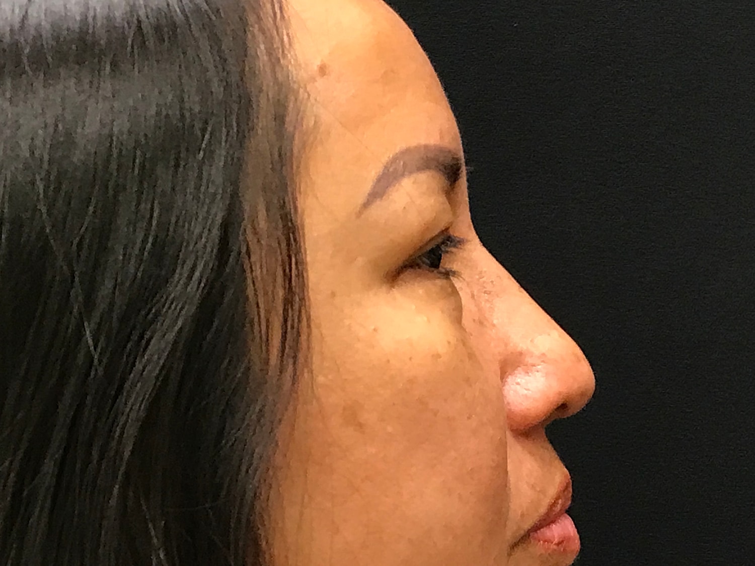 Blephroplasty [.block]Gallery[] Before & After