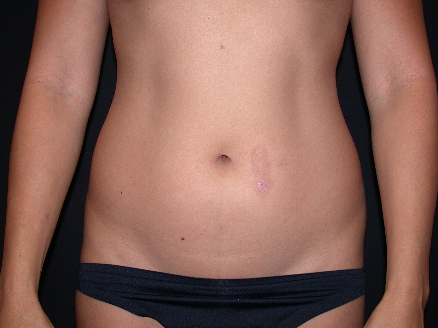 Liposuction Before & After