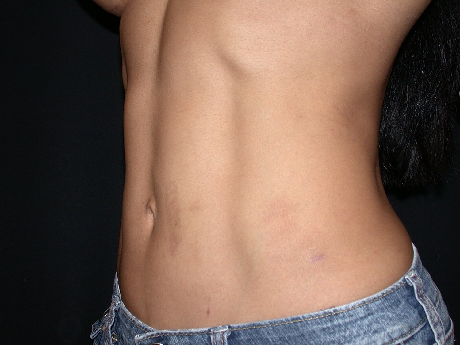 Liposuction Before & After