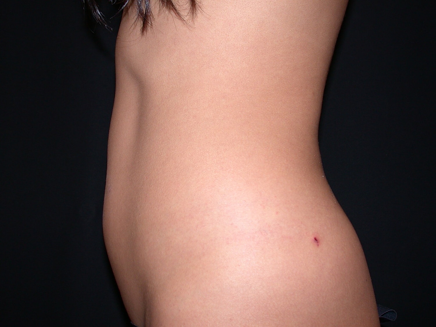 Liposuction Before & After