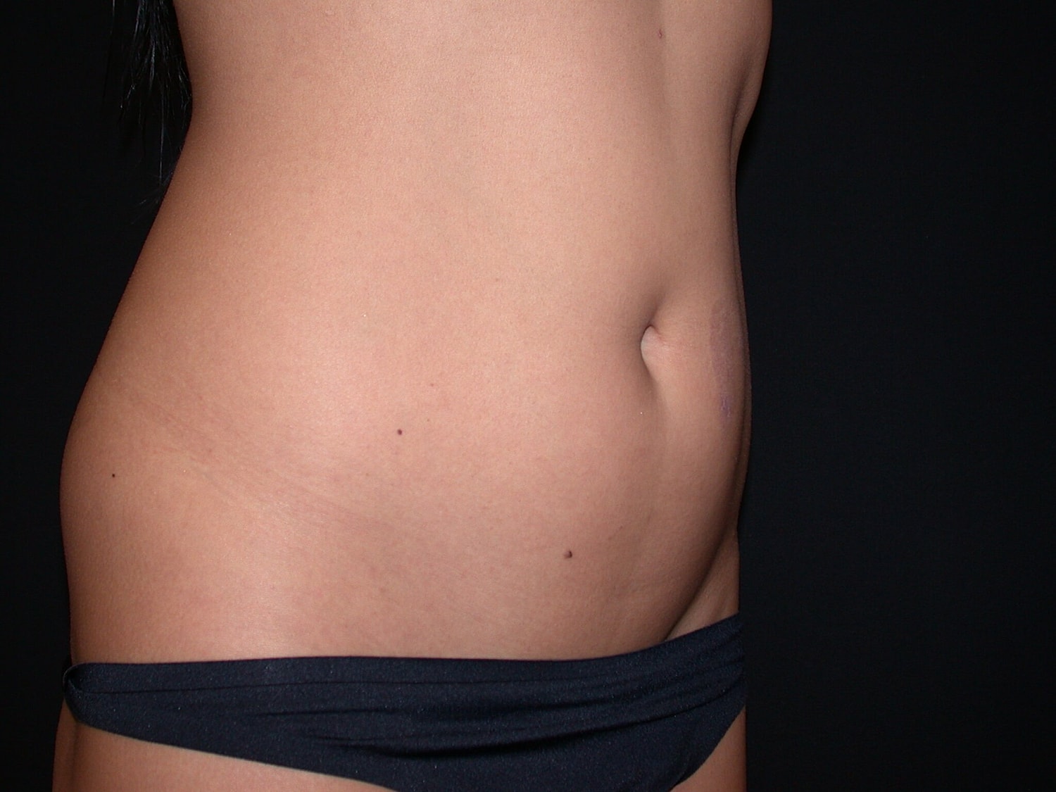 Liposuction Before & After