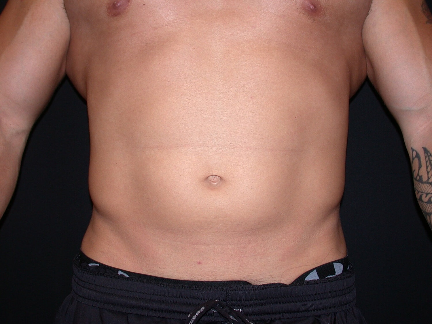 Liposuction Before & After