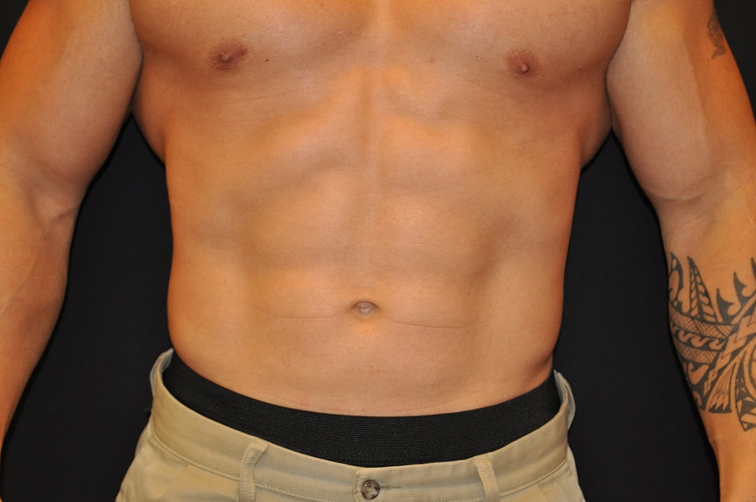 Liposuction Before & After