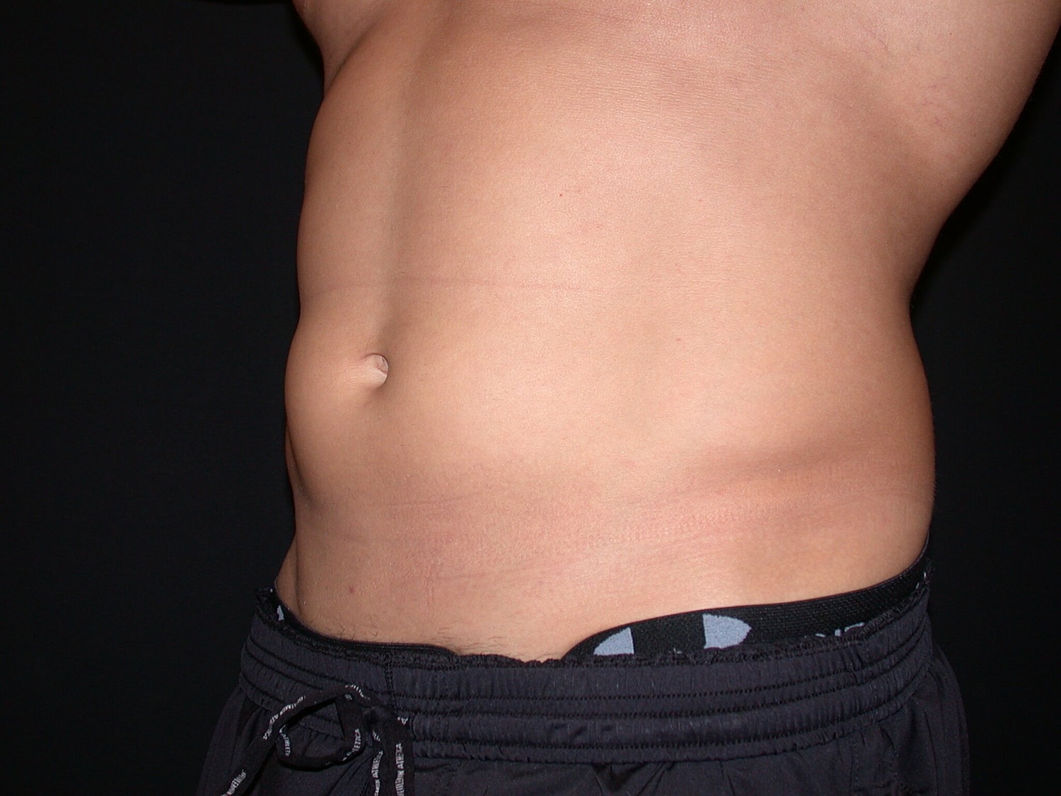 Liposuction Before & After