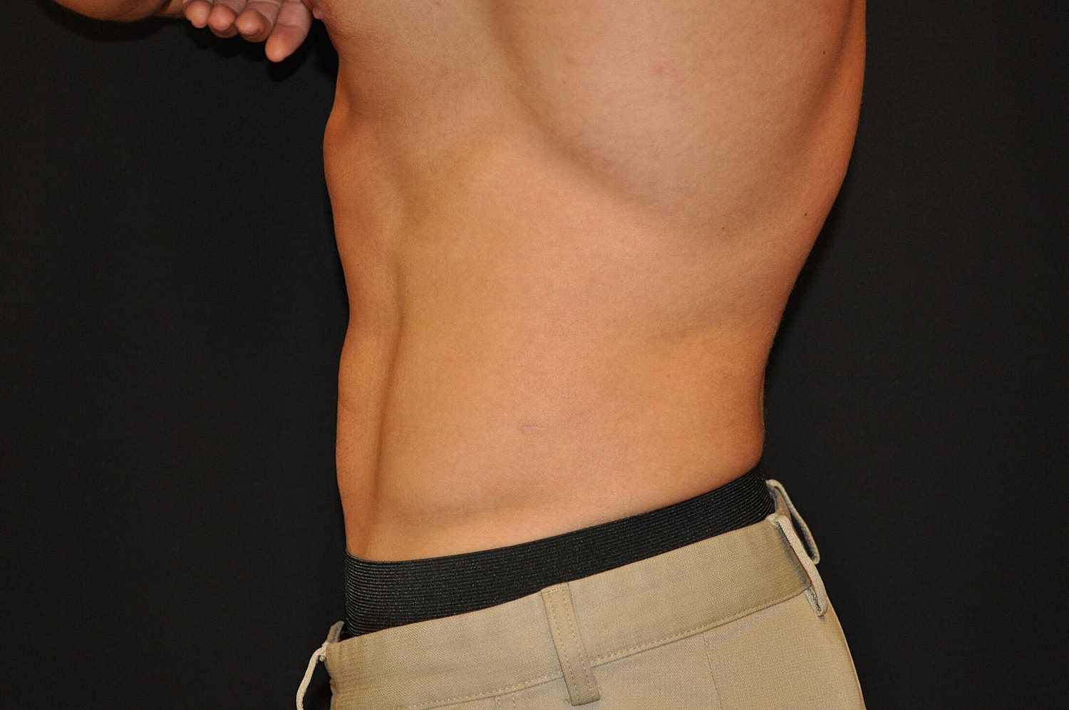 Liposuction Before & After