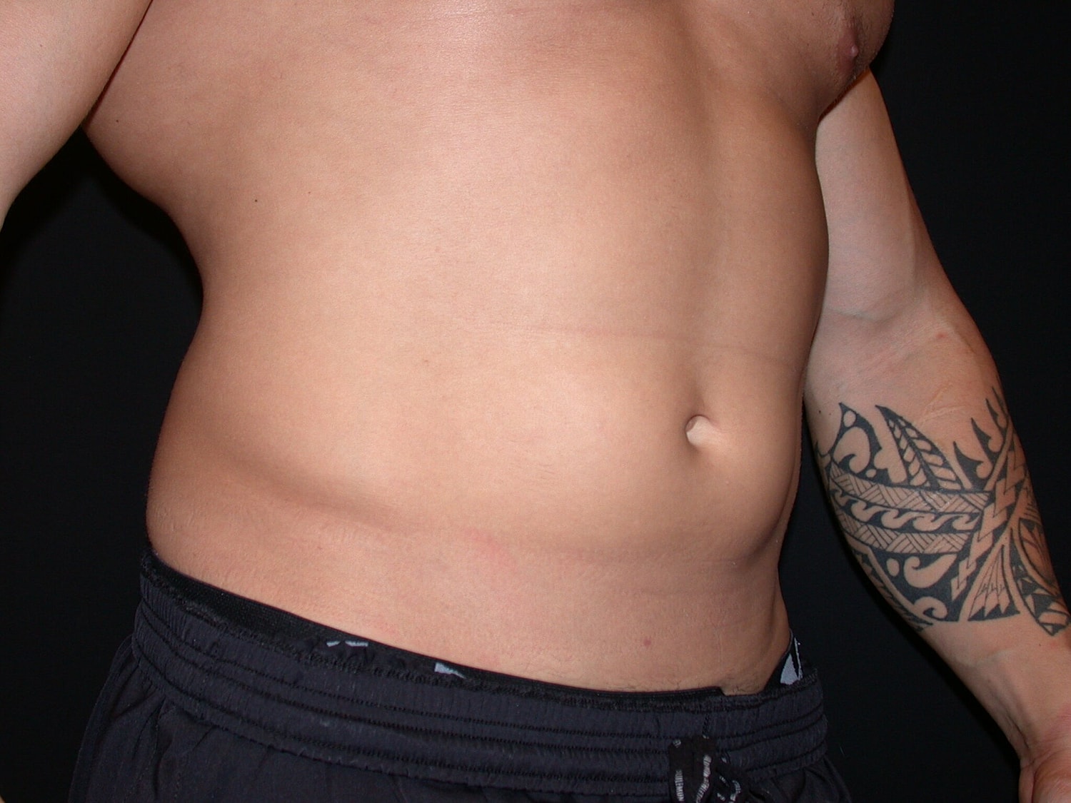 Liposuction Before & After