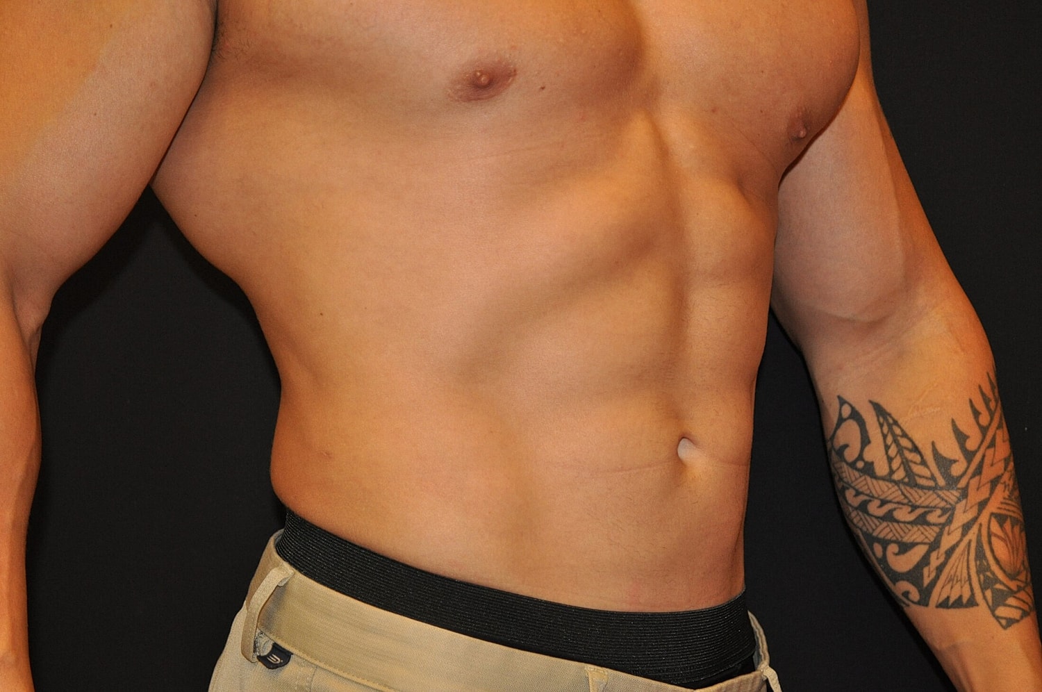 Liposuction Before & After